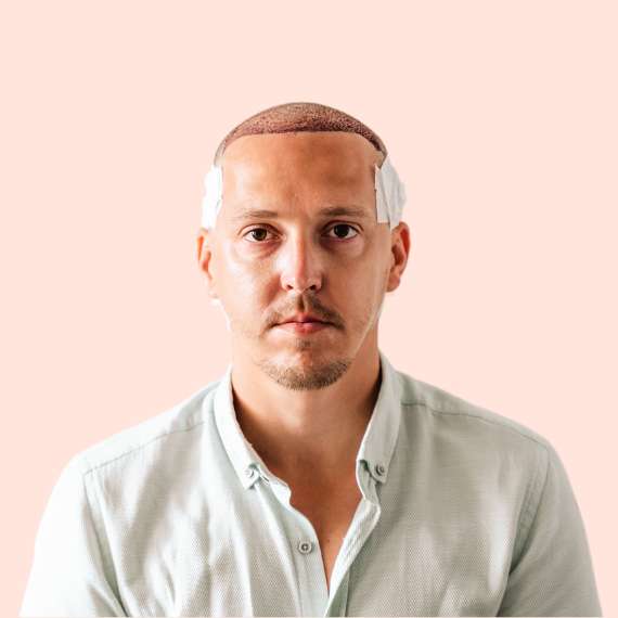 male patient hair transplant result
