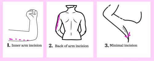 Brachioplasty steps