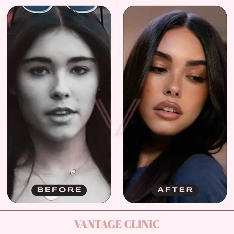 20 Celebrity Rhinoplasty Before & After: Iconic Transformations
