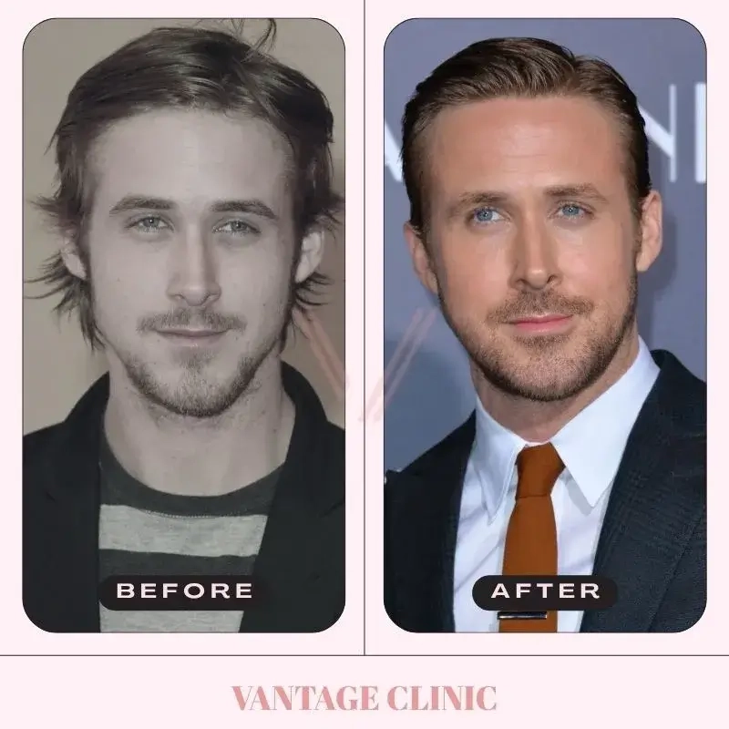 Featured - Ryan Gosling Nose Job